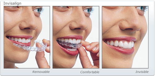 invisalign